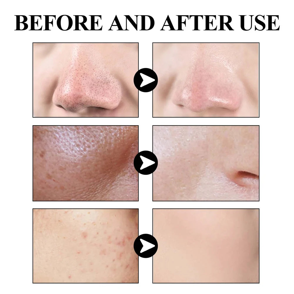West Month Blackhead Mud Mask Controls Oil Shrinks Pores and Moisturizes